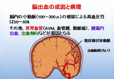 脳卒中治療 | MIRAI病院 | 香川県坂出市